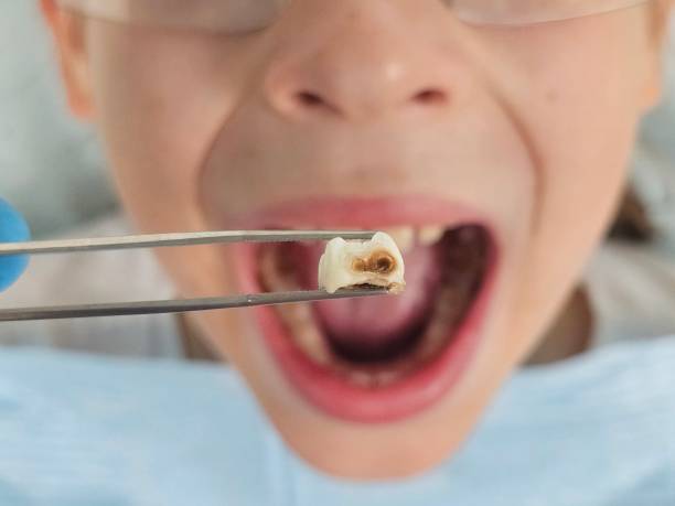 Best Emergency Dental Extractions in Lovell, WY